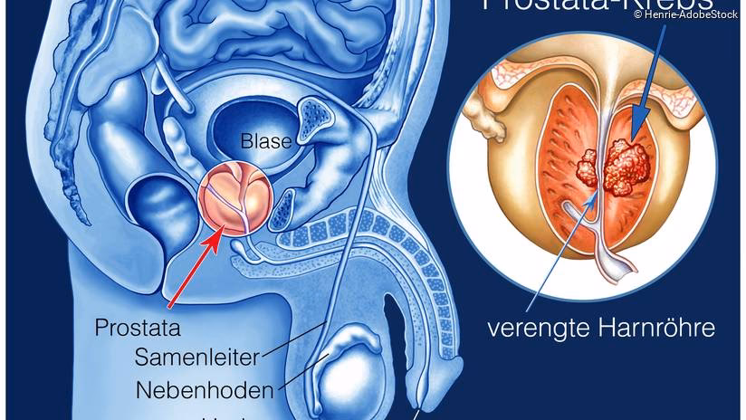 Was tun bei einer chronischen Prostataentzündung?