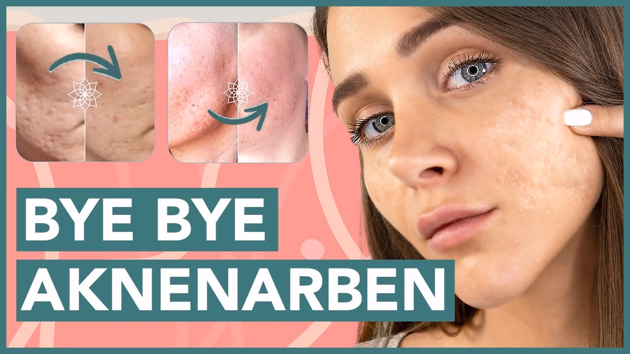 Welche Arten von Aknenarben gibt es?