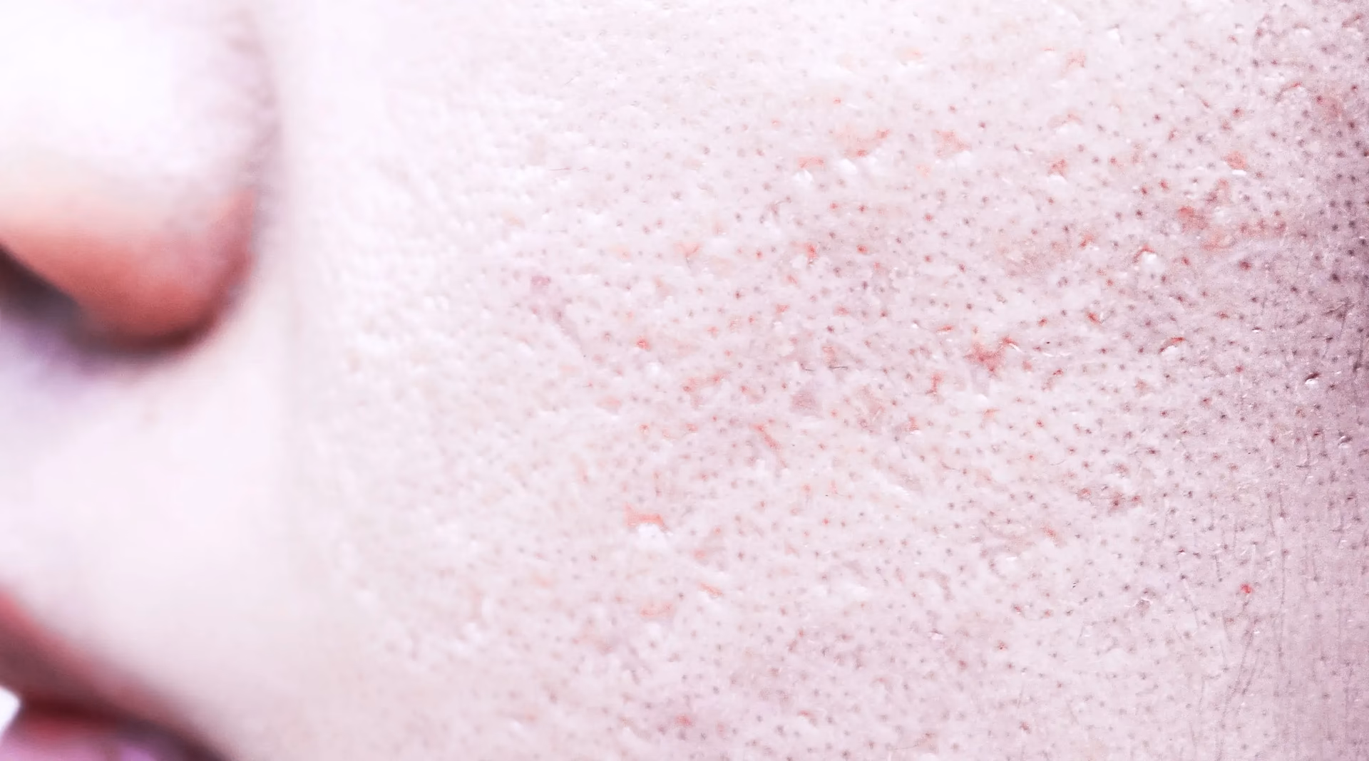 Wann ist ein Peeling beim Dermatologen empfehlenswert?