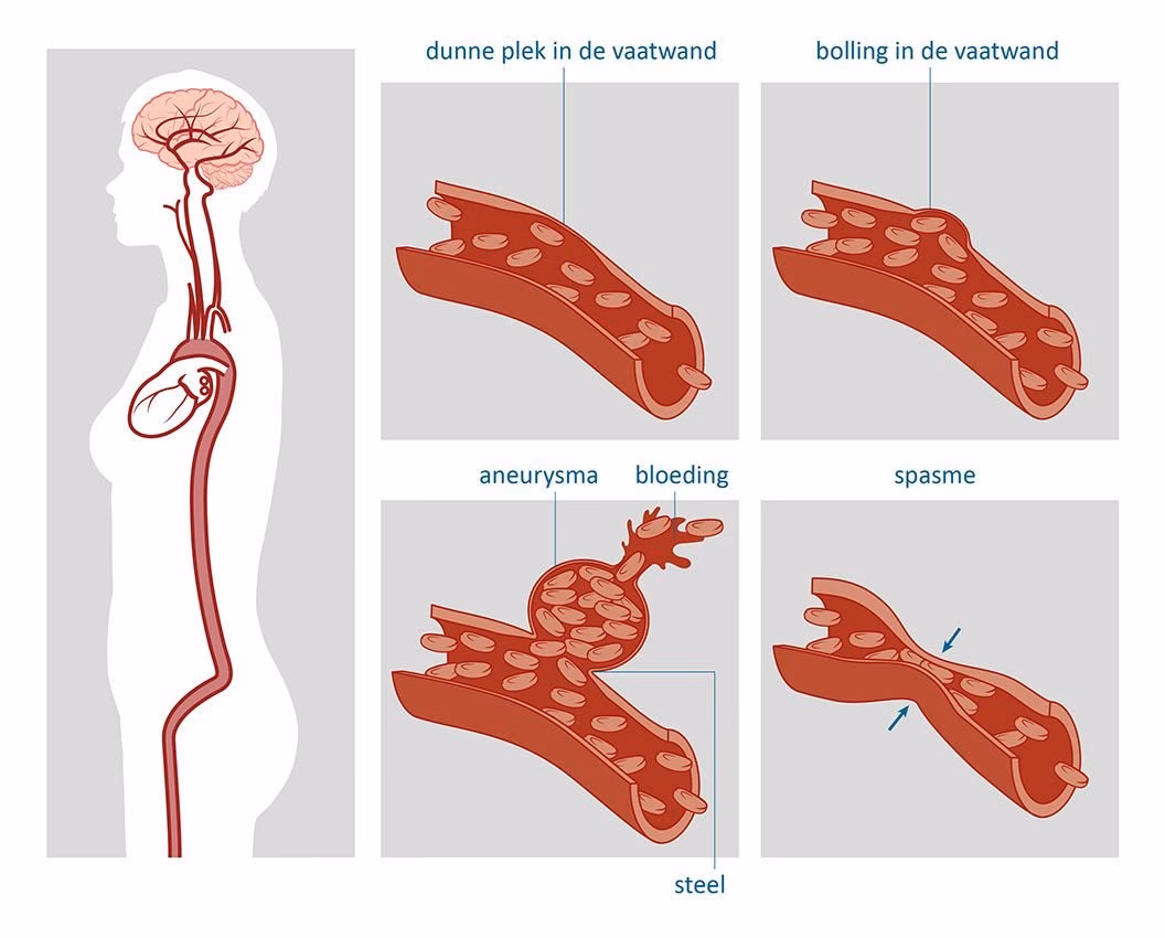 Wie gefährlich ist ein Aneurysma der Aorta?