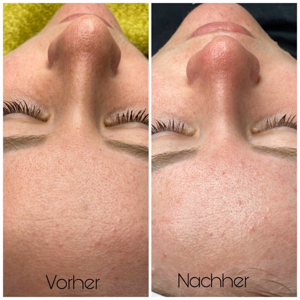 Was ist ein Aqua Peeling?