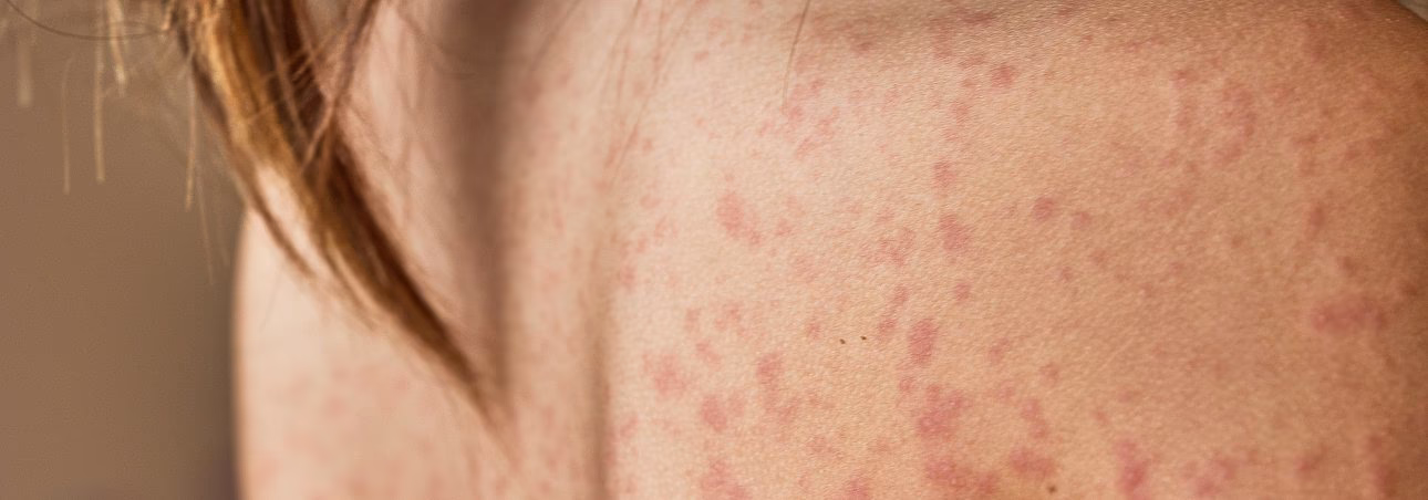Was ist ein Hautausschlag während einer Antibiotika-Therapie?