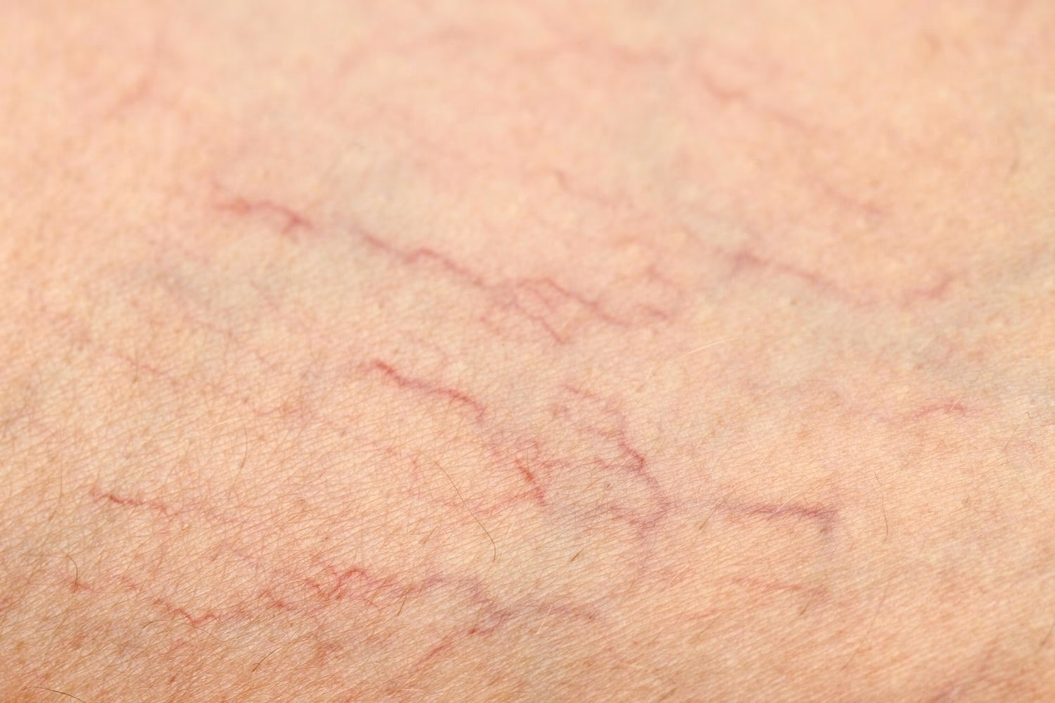 Was sind die Ursachen von Besenreisern?