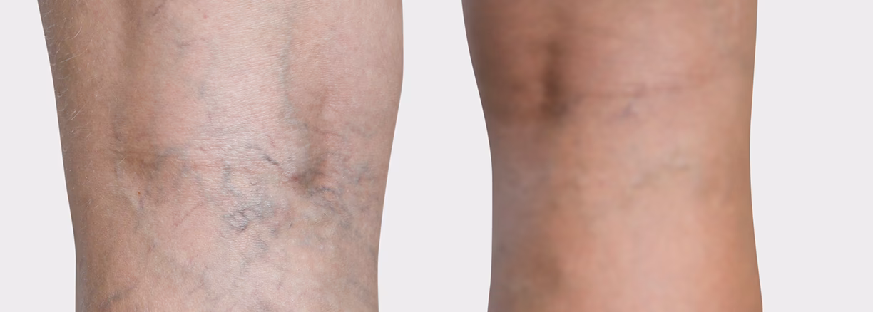 Wie kann man Besenreiser lindern?