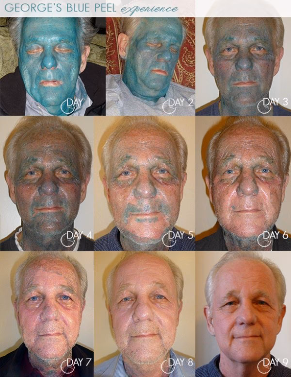 Was kostet ein chemischer Peel?