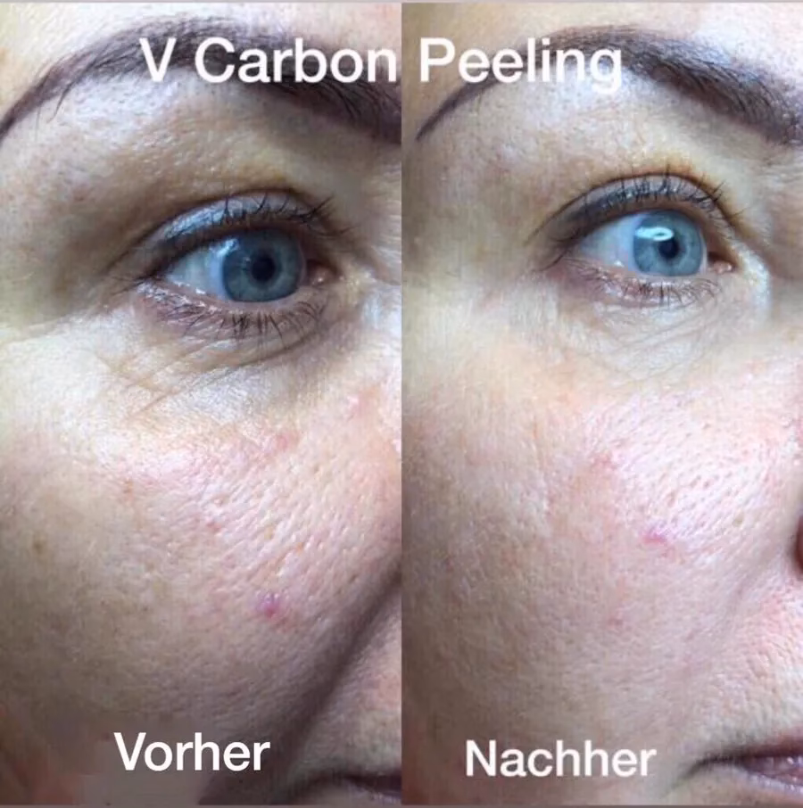 Was ist Carbon Laser und wie wirkt es?