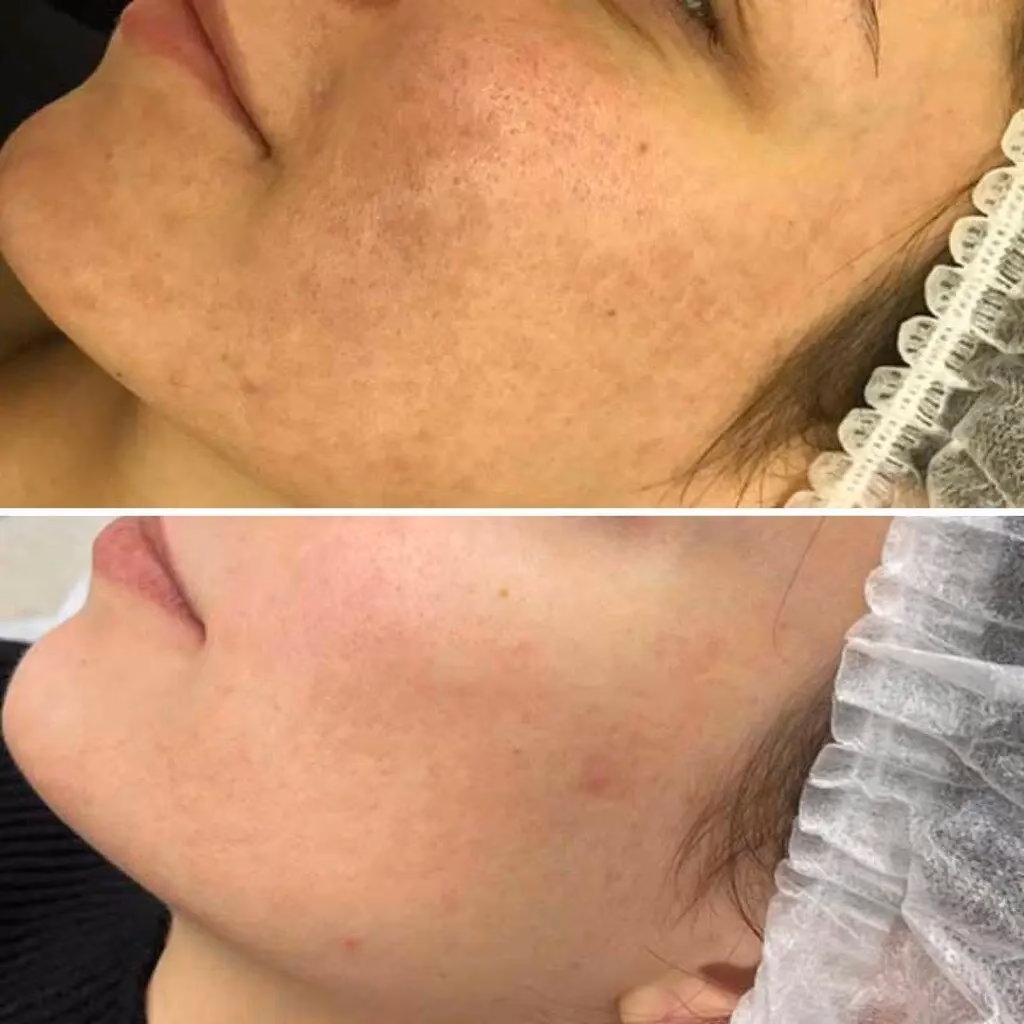 Wann kann man ein Peeling anwenden?