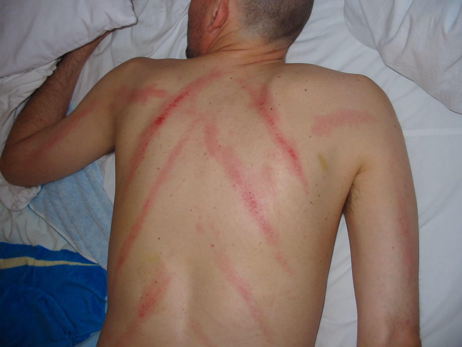 Was bedeuten blaue Flecken auf der Haut?