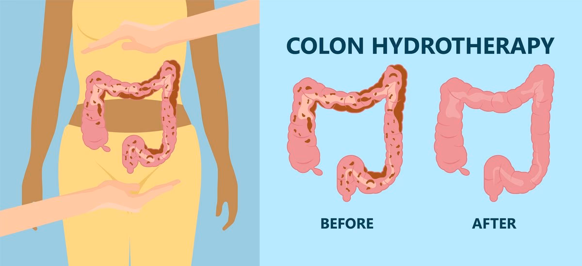 Welche Gefahren birgt die Colon-Hydro-Therapie?