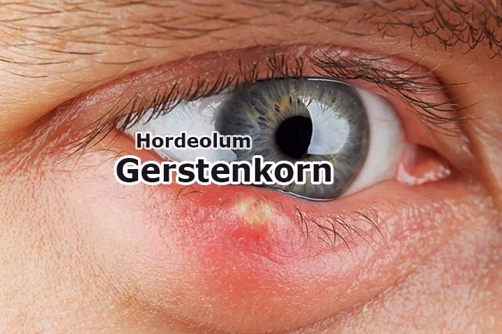 Wie gefährlich sind Hagelkörner?