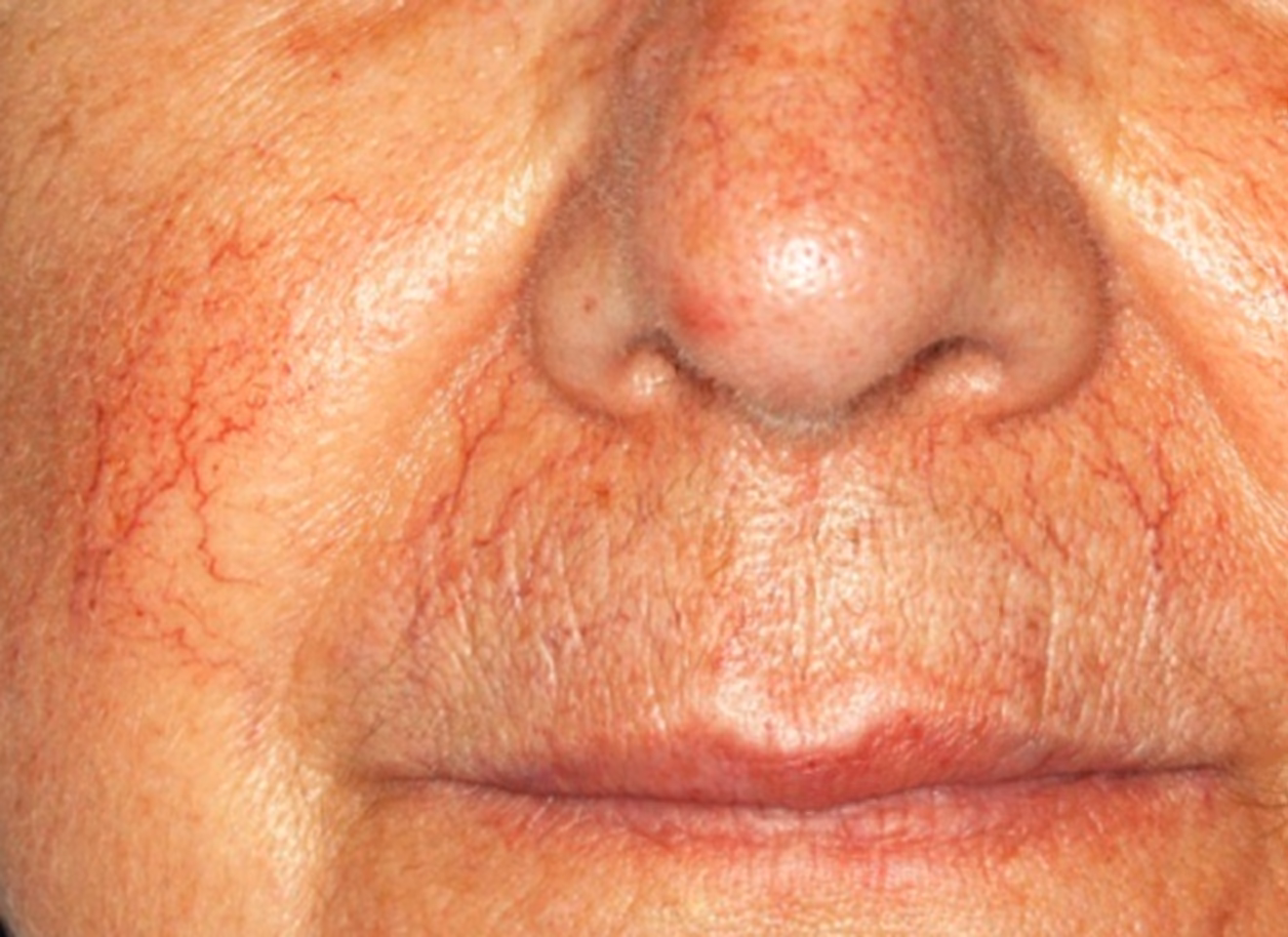 Was sind die Symptome von rosacea?