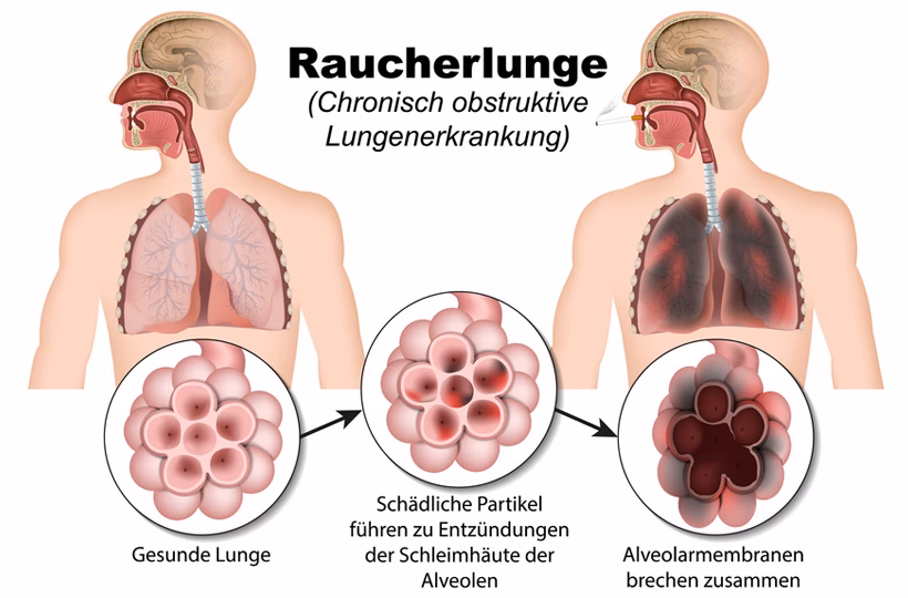 Wie kann man COPD-Patienten ihren Kreislauf stimulieren?