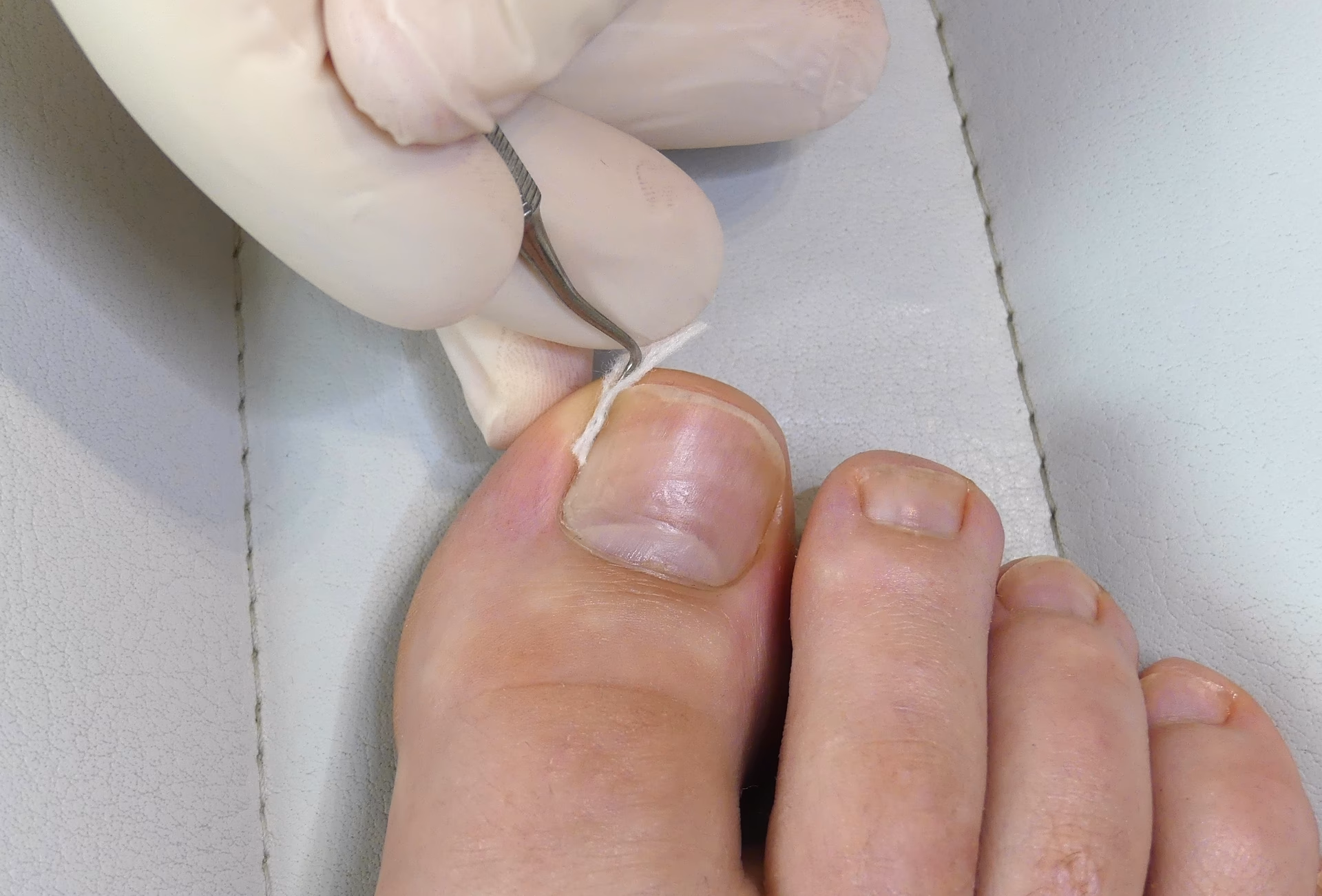 Was ist ein eingewachsener Fußnagel?