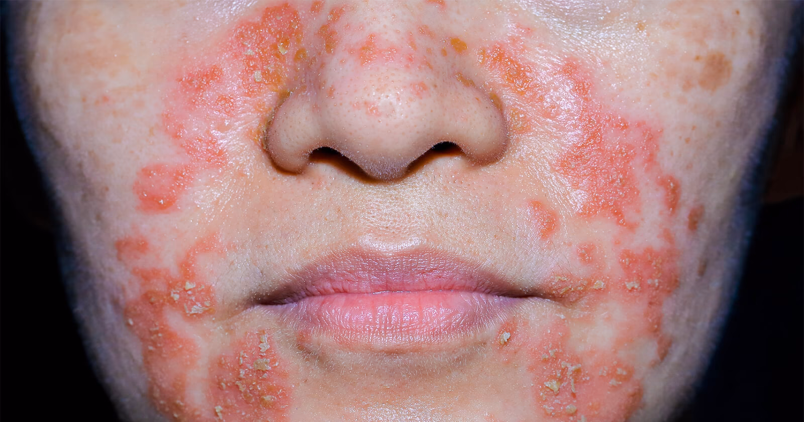 Wie erkenne ich Hautpilz?