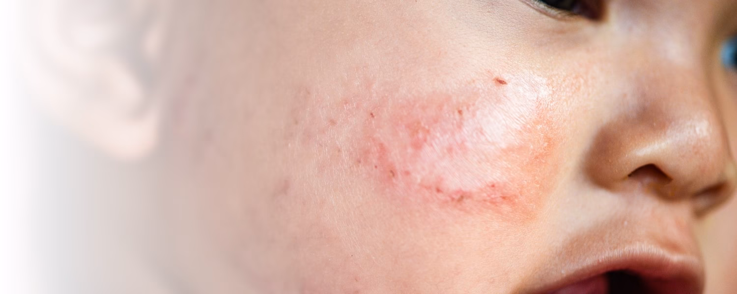 Ist seborrhoisches Ekzem heilbar?