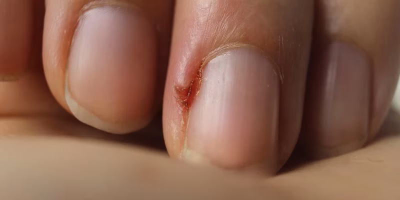 Wie erkenne ich eine nagelhautentzündung?