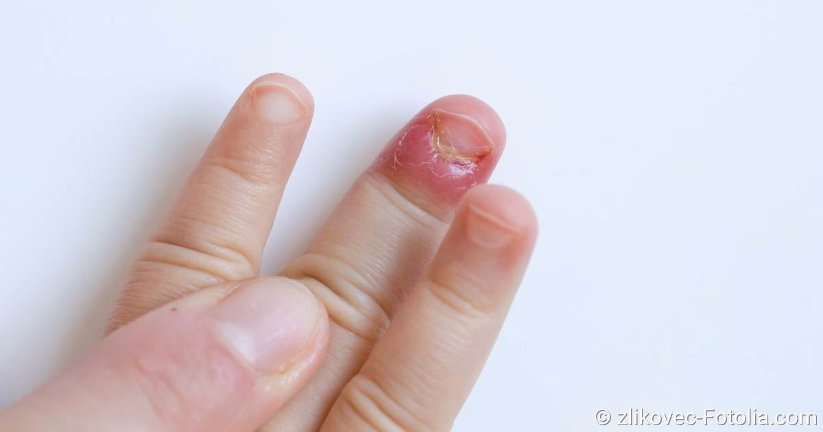 Was sind Risikofaktoren für eine chronische Nagelbettentzündung?
