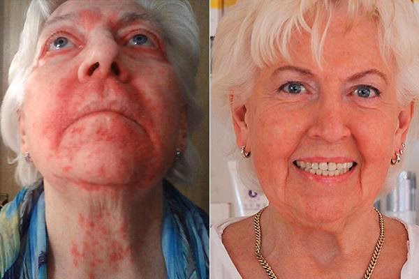 Wie sieht die Haut bei Rosazea aus?