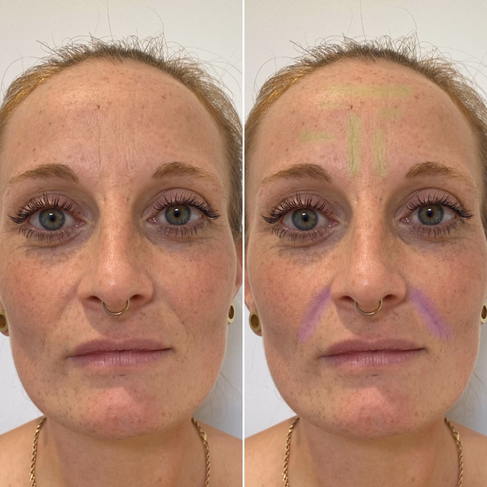 Was ist eine Laserbehandlung im Gesicht?