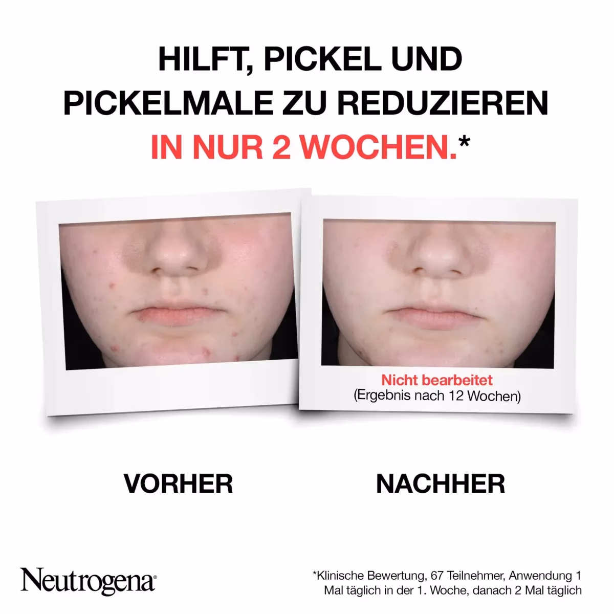 Wie sieht ein Pickel nach Akne aus?