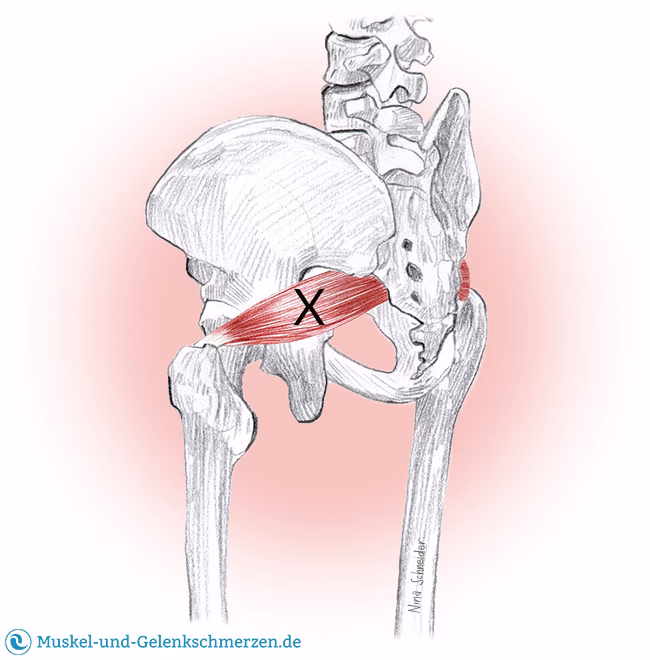 Wie kann man Schmerzen am Gesäß lindern?