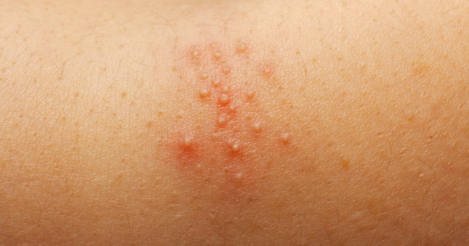 Was sind die Ursachen für Pickel?