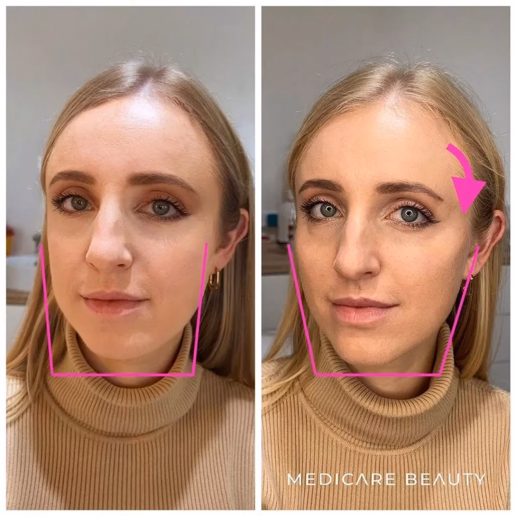 Welche Hyaluronsäure für Lippen?