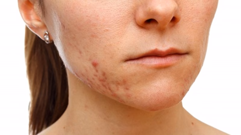 Was hilft gegen Pickel und Akne?