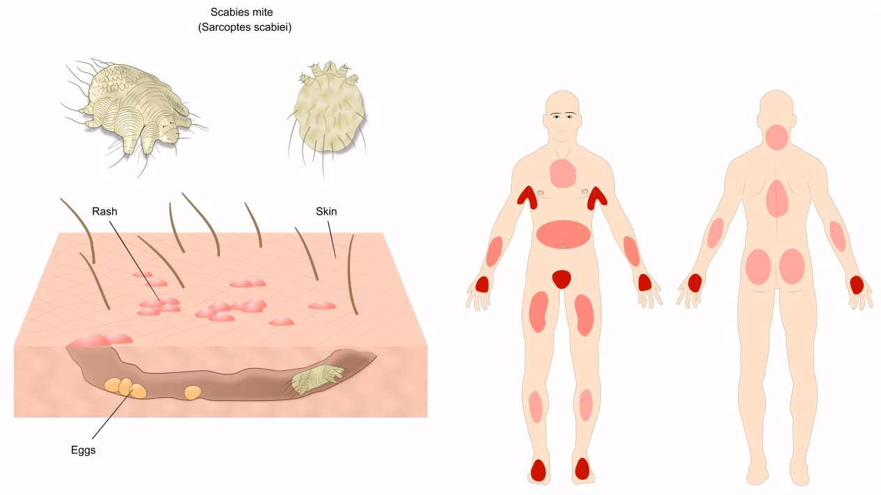 Wie erkenne ich Krätzmilben?