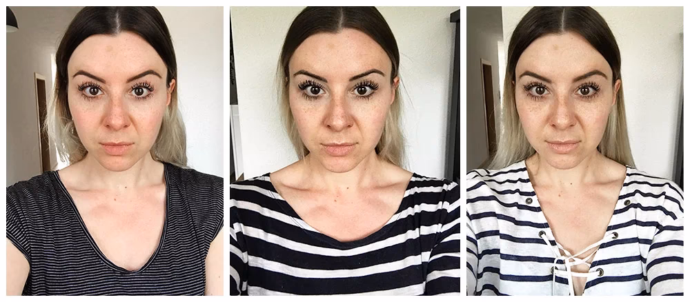 Was kostet eine Laserbehandlung?