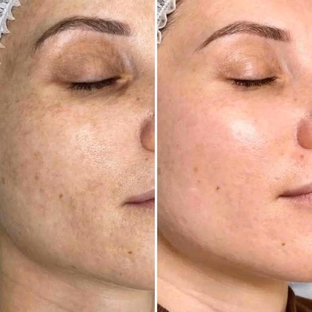 Welche Arten von Laserbehandlungen gibt es?