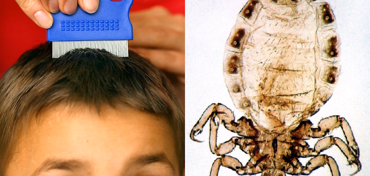 Wie entferne ich Läuse und Nissen?