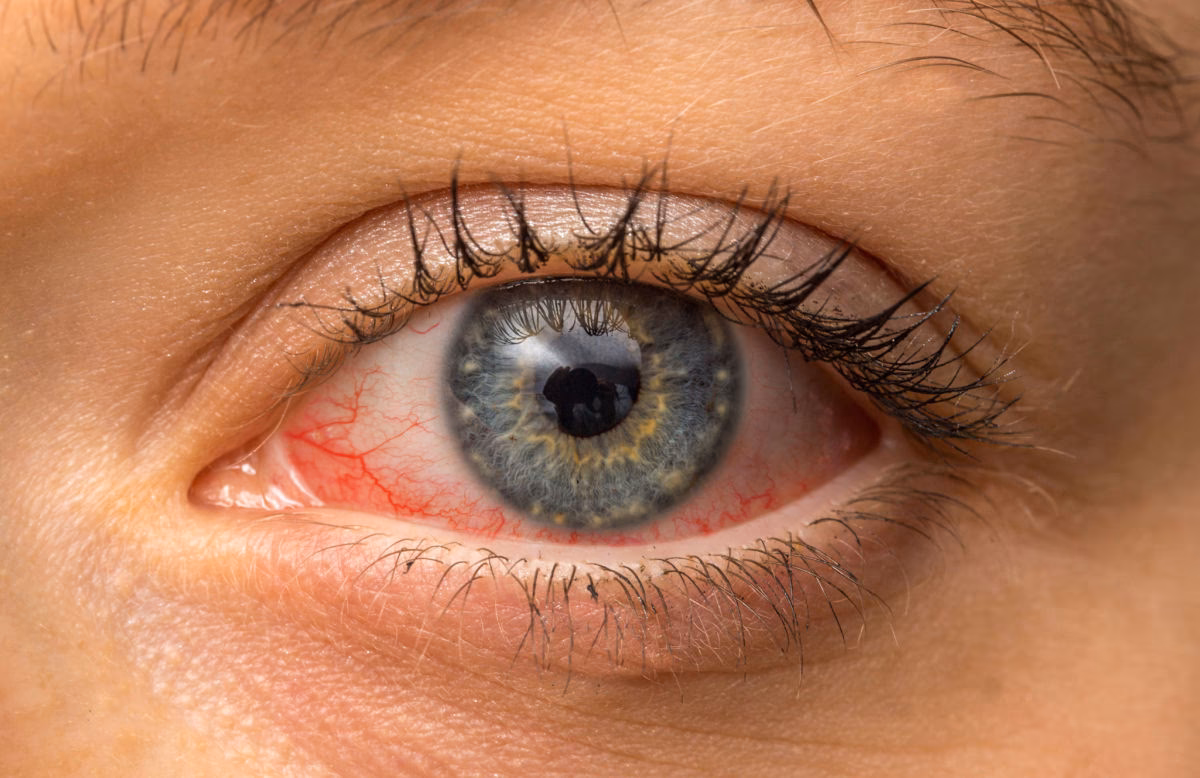 Was ist der Unterschied zwischen einer akuten und einer chronischen Lidrandentzündung?