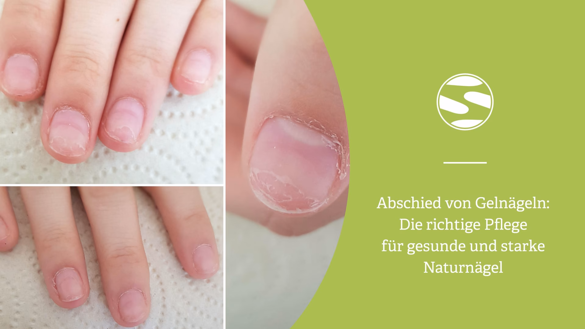 Was hilft gegen Gel-Nägel?