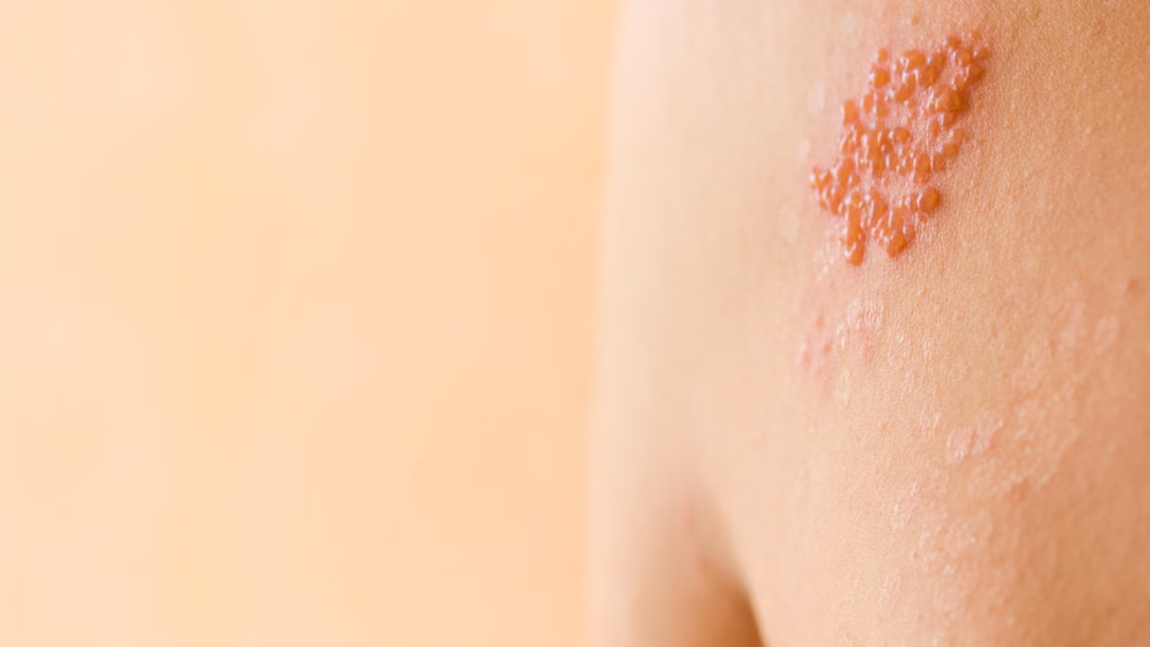 Was ist der Unterschied zwischen Varicella-Zoster und Herpes Zoster?