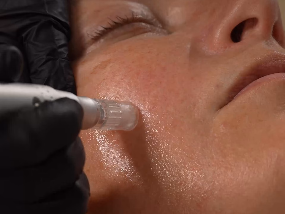 Was ist ein mikropeeling?