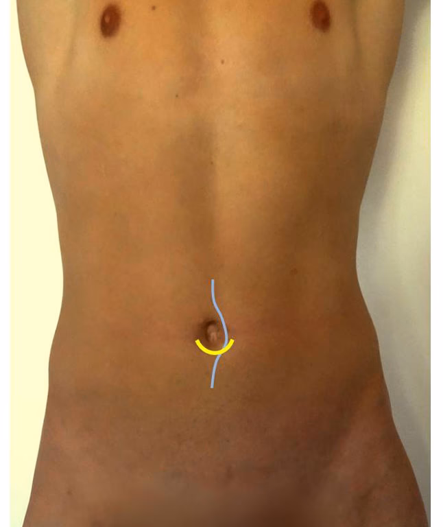 Wie lange dauert es bis man nach einer Nabelbruch op wieder fit ist?