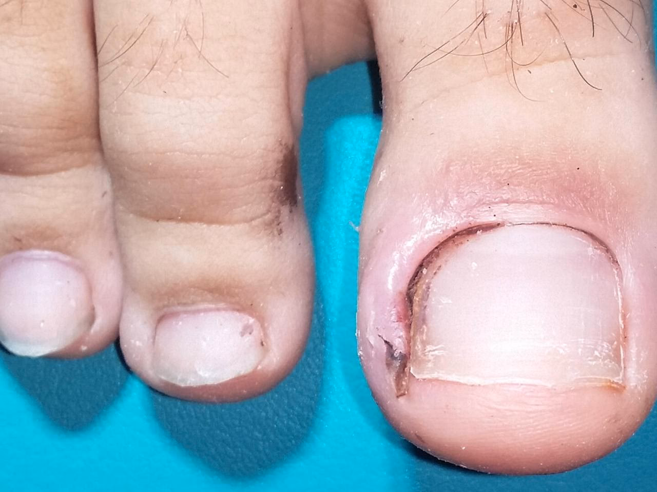 Wie behandelt man einen eingewachsenen Nagel?