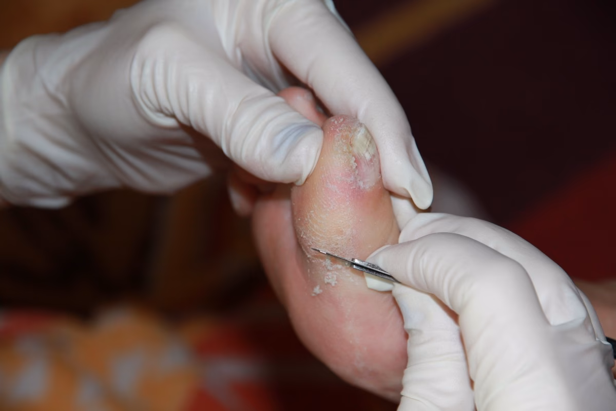 Warum bekommt man Hornhaut in den Füßen?