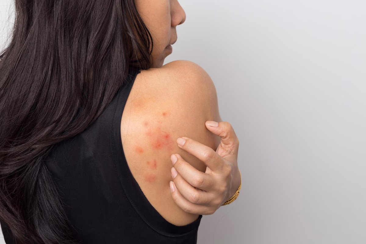 Was ist eine Krätze?