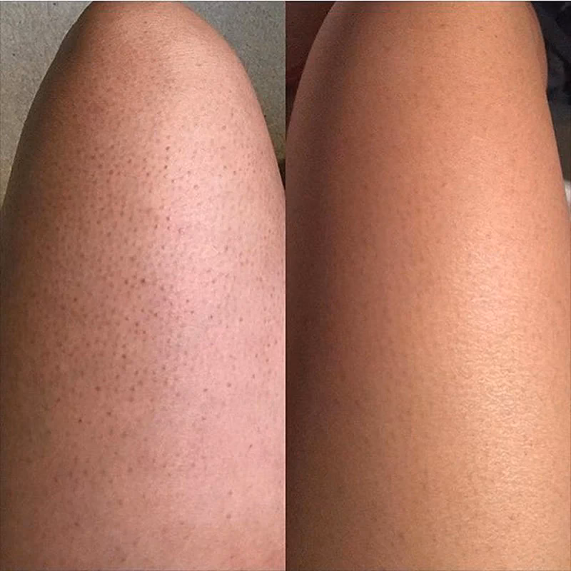 Wie pflege ich meine Haut nach einem Peeling?