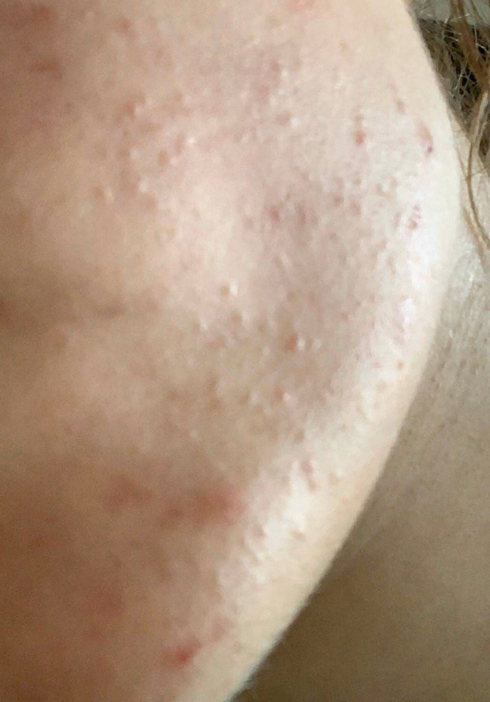 Was ist ein BHA Peeling?