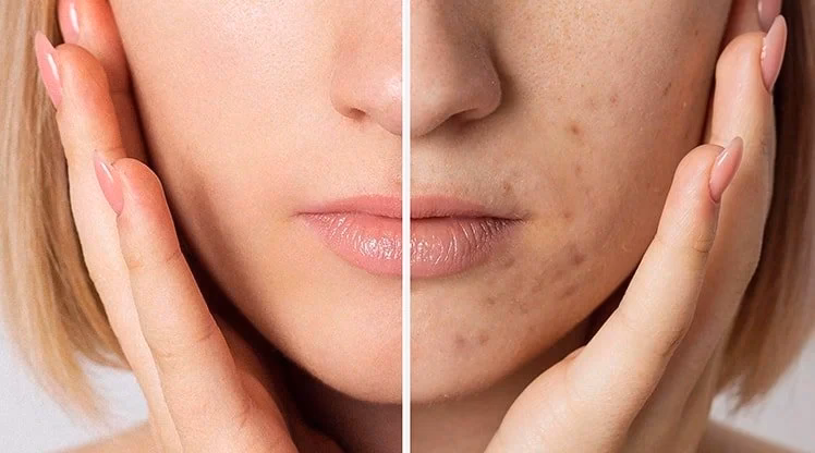 Was hilft gegen Pickel und Akne?