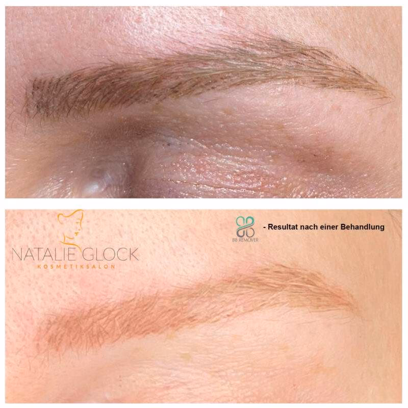 Was ist eine PMU-Entfernung?