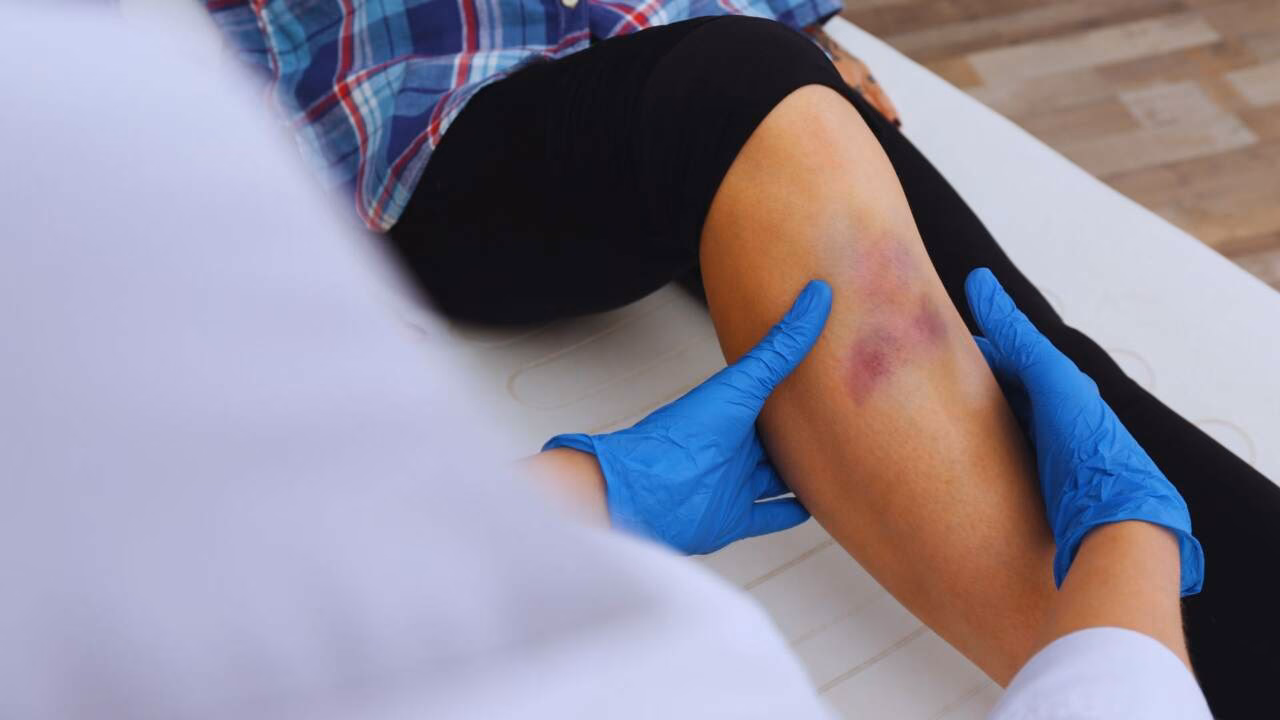 Was ist bei Prellung besser: Kälte oder Wärme?