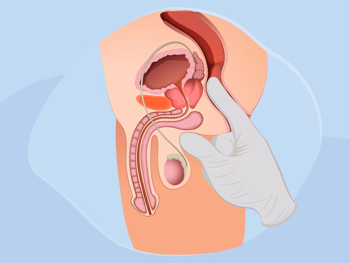 Wie kann man die Prostata am besten fühlen?