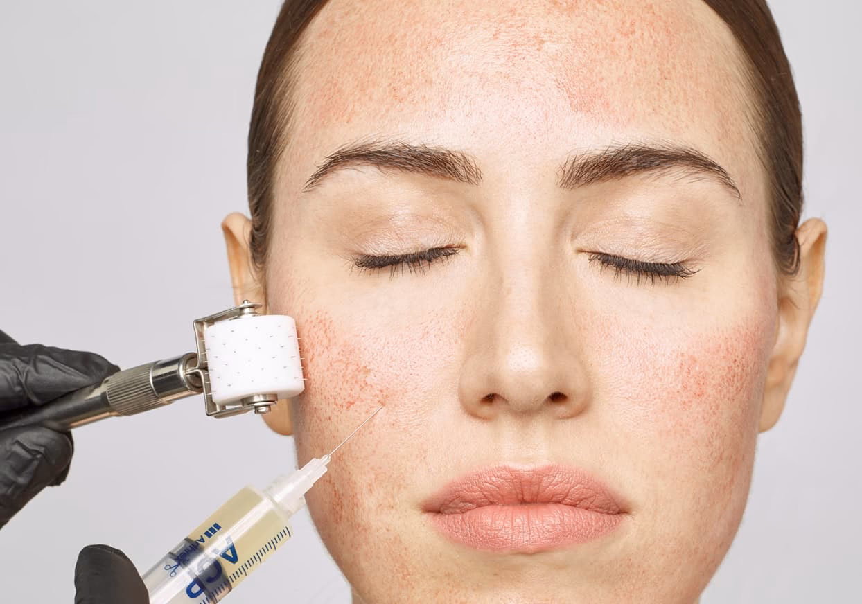 Wie lange dauert die PRP-Behandlung gegen Falten?