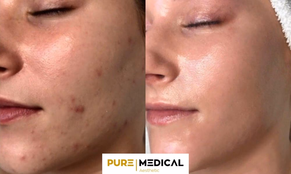 Was sind die Nebenwirkungen von PRP?