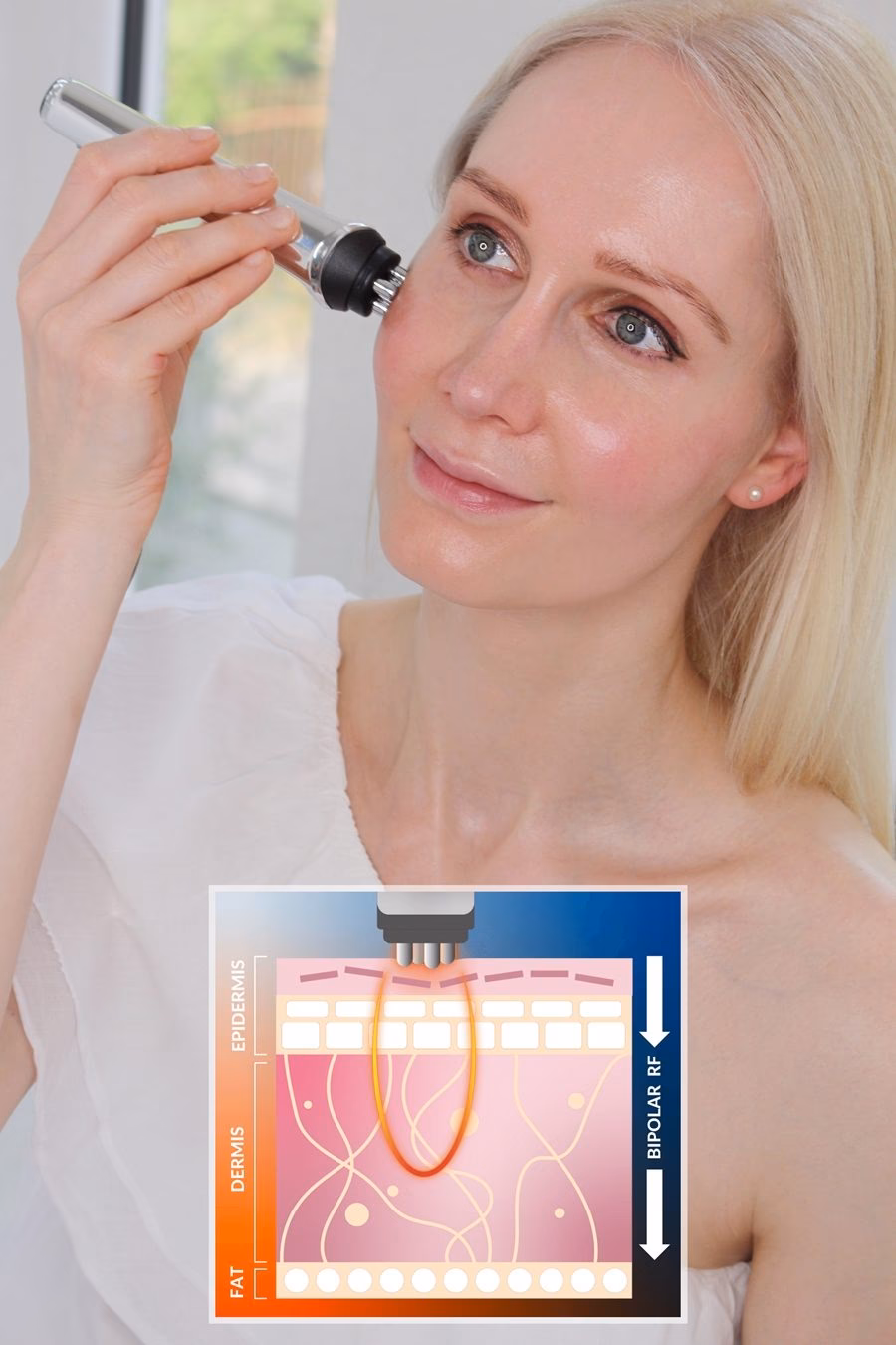 Was sind die Nebenwirkungen einer Radiofrequenz-Therapie?