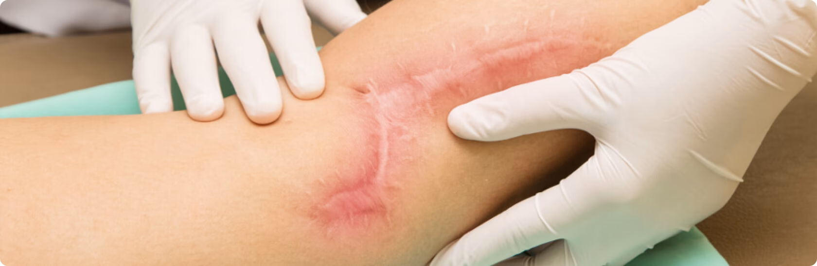 Was sind die Ursachen für juckende Narben?